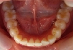 dientes inferiores visto por dentro