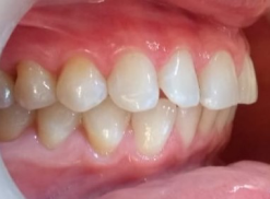 foto de dientes forma lateral