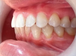 foto de dientes forma lateral