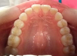 dientes superiores visto por dentro